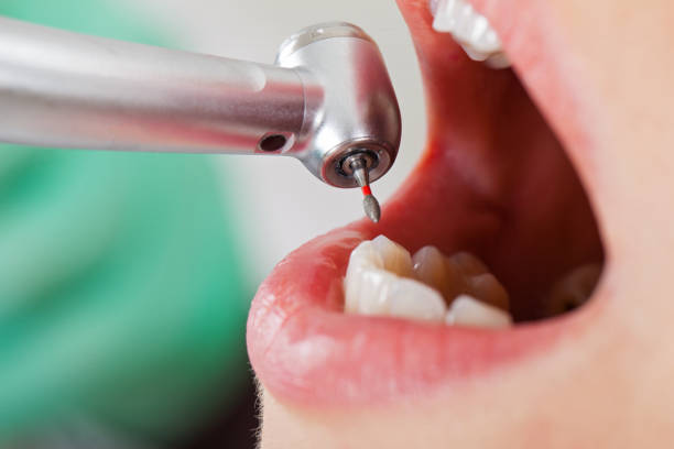 Best Emergency Wisdom Teeth Removal in North Madison, OH